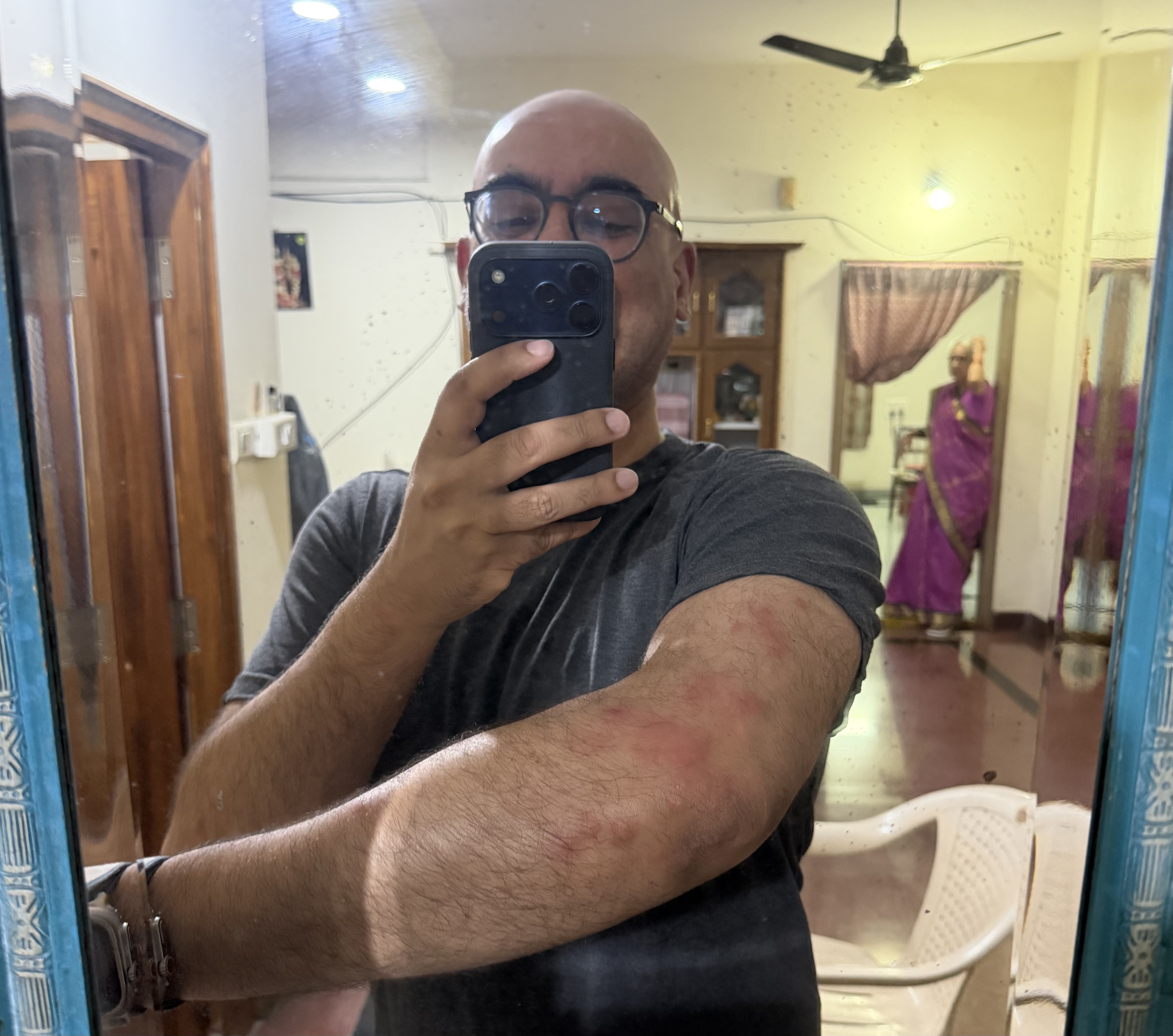 The mosquitos got me good